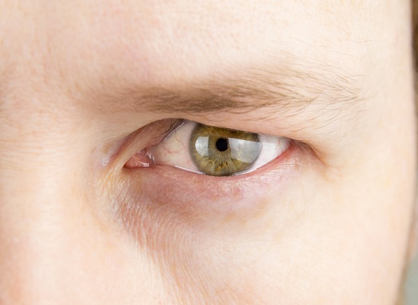 Droopy Eyelid Causes Symptoms And Treatment Of Ptosis