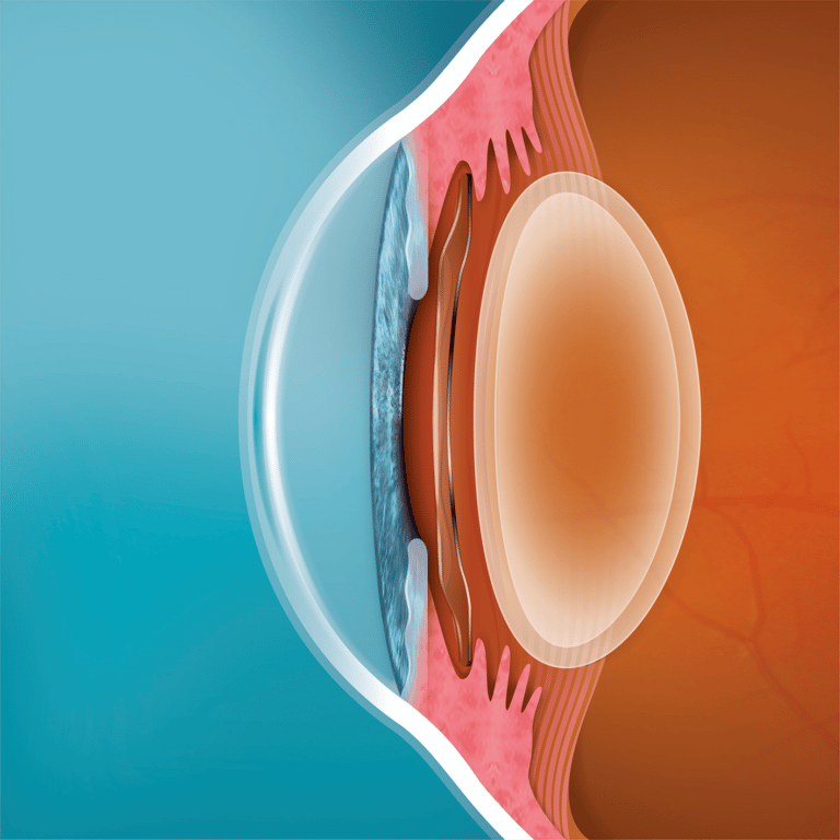 Evo Visian Icl Eye Surgery Visian Implantable Collamer Lens